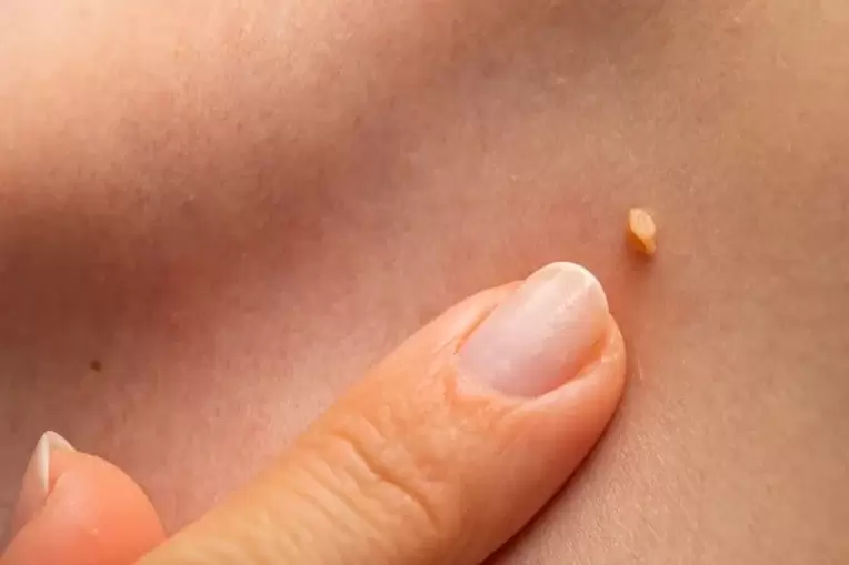 Papiloma pada kulit