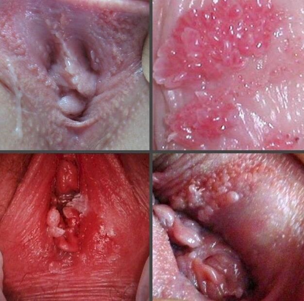 Tampilan jarak dekat dari papiloma di vagina