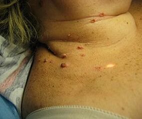 virus papiloma manusia di leher