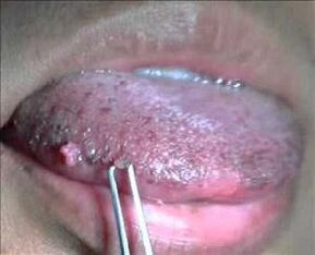 virus papiloma manusia di lidah