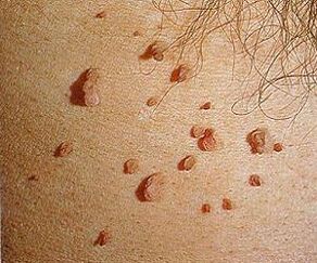 virus papiloma manusia pada kulit