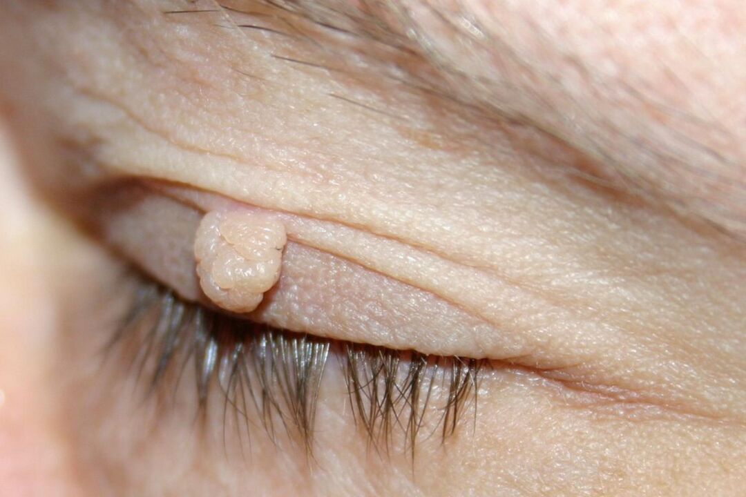 gejala papiloma pada kelopak mata