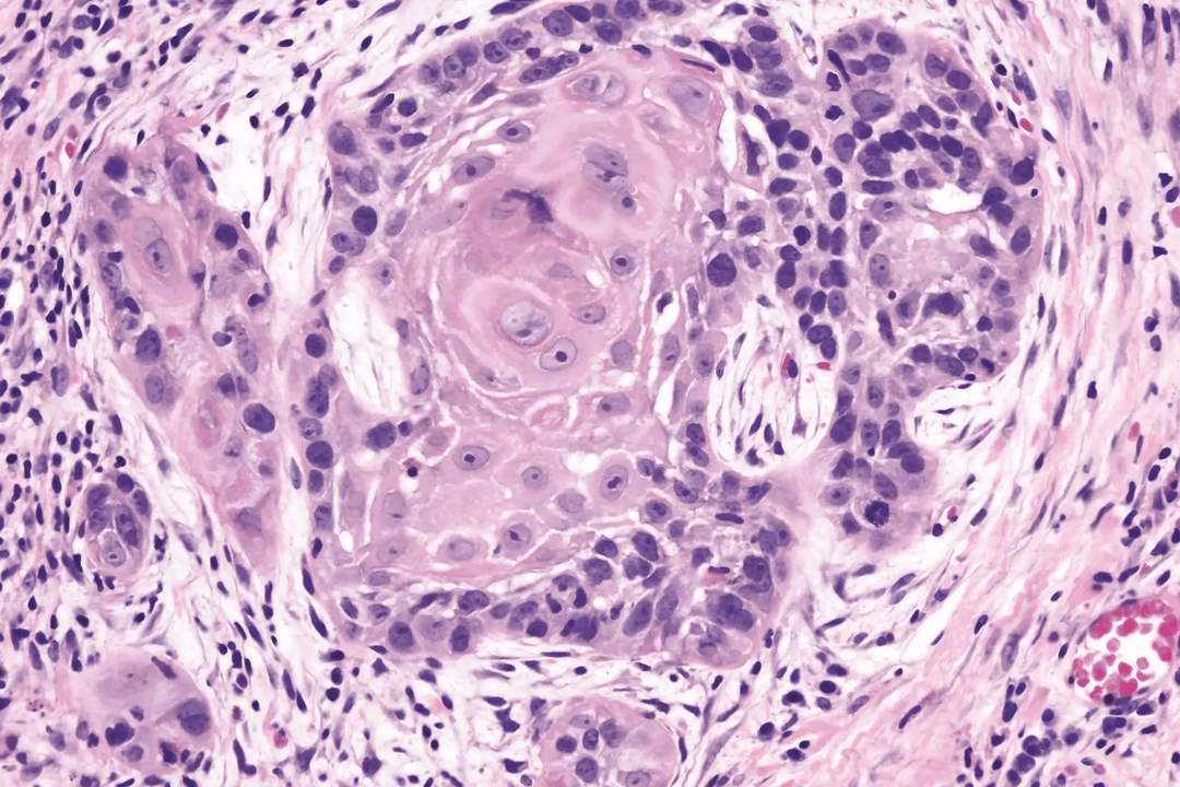 pengobatan papiloma sel skuamosa
